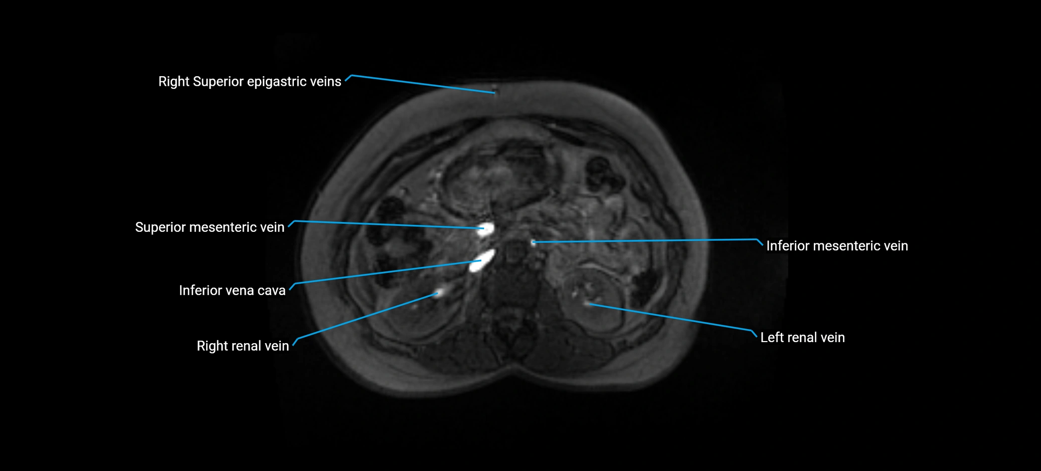 MRV abdomen pelvis & lower limb axial cross sectional anatomy labelled MRI image 70 (1).webp